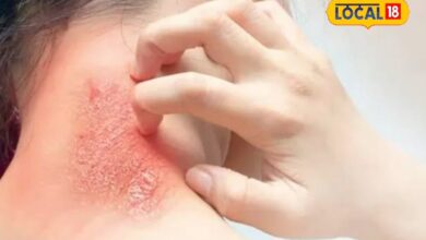 Increasing heat can cause skin diseases, keep these things in mind – News18 हिंदी