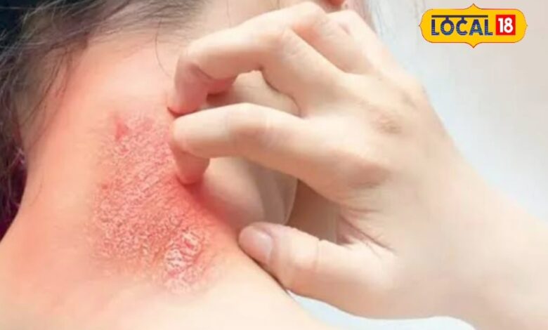 Increasing heat can cause skin diseases, keep these things in mind – News18 हिंदी