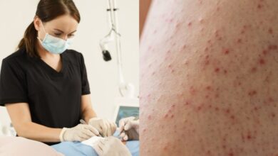 Keratosis Pilaris: 40% वयस्कों को स्किन की यह बीमारी, 50 से 80 पर्सेंट टीनएजर्स होते हैं प्रभावित, जानें कैसे पाएं छुटकारा