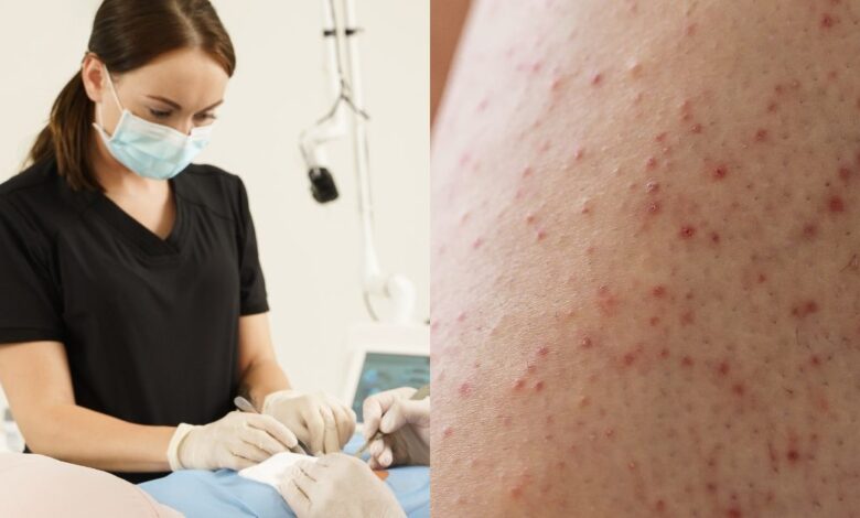 Keratosis Pilaris: 40% वयस्कों को स्किन की यह बीमारी, 50 से 80 पर्सेंट टीनएजर्स होते हैं प्रभावित, जानें कैसे पाएं छुटकारा