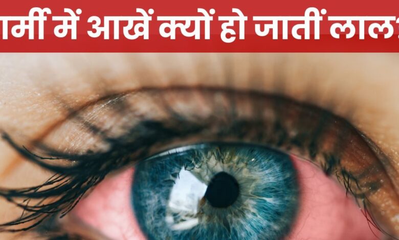 गर्मी में आंखें लाल क्यों हो जाती हैं? 99% लोगों में होती है कंफ्यूजन, डॉक्टर से जानें कारण और राहत पाने के उपाय