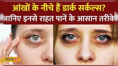 Eyes के नीचे Dark Circles से हैं परेशान तो Lifestyle और Diet में करें ये बदलाव, मिलेगा आराम #local18