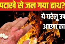 Diwali Safety Tips: दीये-पटाखों से जल गई उंगली? तुरंत करें ये घरेलू उपाय, जलन से मिलेगी राहत