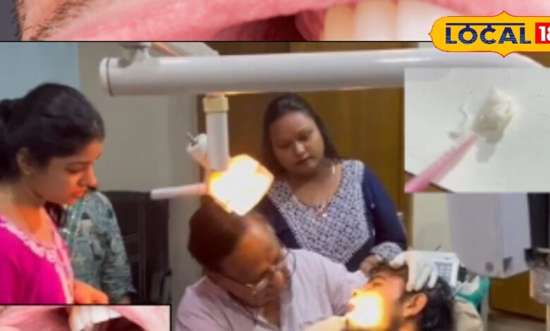 मुंह में छालों के बाद होने वाले कैंसर के लिए रामबाण है यह ओरल जेल, 10 हजार मरीजों को हो चुका फायदा