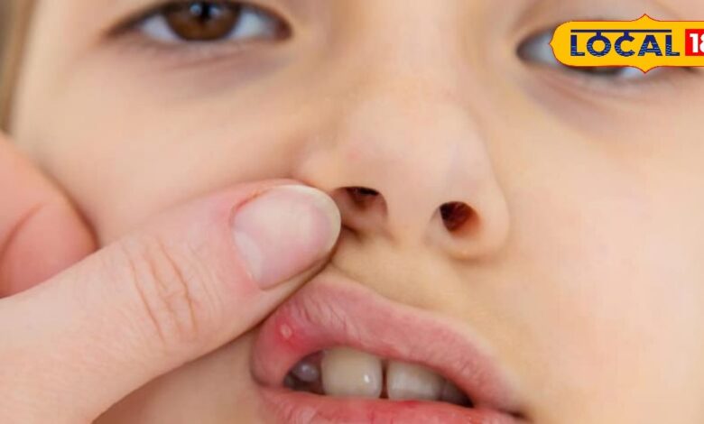 Home Remedies Mouth Ulcer: मुंह में हो गए छाले तो अपनाएं घरेलू ये नुस्खे
