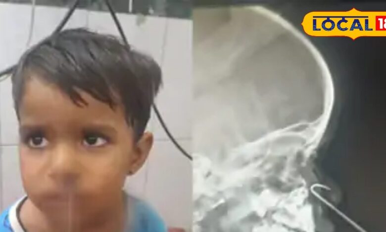 पहले नाक में फंसा मोती फिर फंसी यह तीन इंच की नुकीली चीज...देखकर डॉक्टरों के उड़े होश, ऐसे निकाला