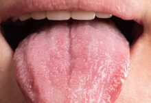 5 changes in tongue indicate dangerous diseases : जीभ में ये 5 संकेत खतरनाक बीमारी