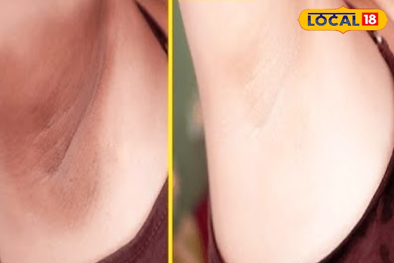 अंडरआर्म्स के कालेपन से छुटकारा पाएं इन 5 घरेलू नुस्खों से, कुछ हफ्तों में दिखेगा असर. अंडरआर्म्स के कालेपन से छुटकारा पाएं इन 5 घरेलू नुस्खों से, कुछ हफ्तों में दिखेगा असर.