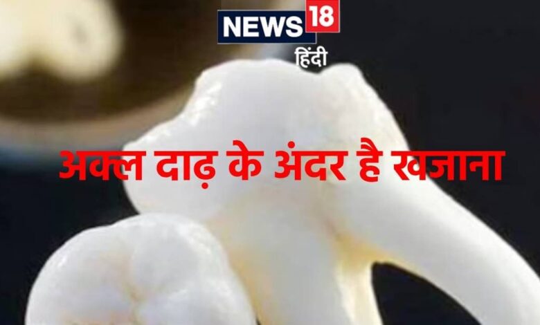 अक्ल दाढ़ में भरा होता है ऐसा खजाना! अब जिससे गंभीर बीमारियों का होगा इलाज, रिसर्च में दावा wisdom teeth stem cells can be revolution in medical treatment research