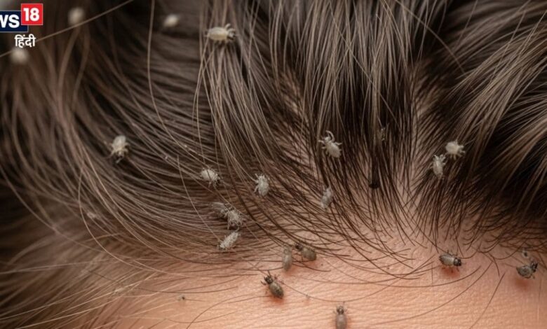 जूं काटने पर सिर में खुजली क्यों होने लगती है? क्या है इसका वैज्ञानिक कारण, जानिए इससे निजात पाने के उपाय