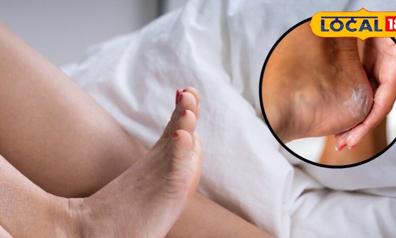 सर्दियों में फटी एड़ियों का घरेलू इलाज और आसान टिप्स