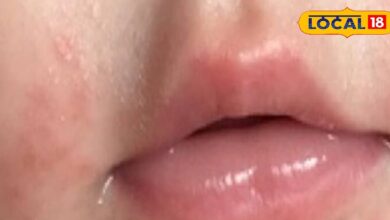 children winter skin care | dry skin remedies for kids | cracked skin solutions children | moisturizing tips kids | winter skin protection for children