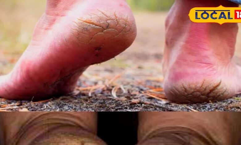 Tips and Tricks: फटी एड़ियों के लिए रामबाण हैं ये घरेलू नुस्खे; दर्द और दरारों से तीन दिन में मिल जाएगी मुक्ति! - Rajasthan News