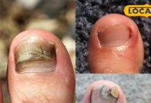 बिना चोट लगे क्यों पक जाता है पैर का अंगूठा, ये वजह पड़ जाती है भारी, छुटकारा आसान, जानें कैसे?