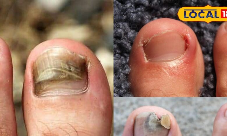 बिना चोट लगे क्यों पक जाता है पैर का अंगूठा, ये वजह पड़ जाती है भारी, छुटकारा आसान, जानें कैसे?