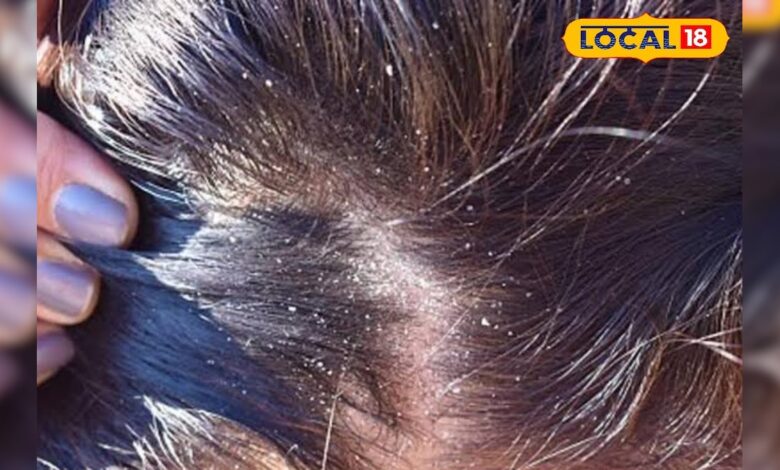 सर्दियों में रूसी से बाल झड़ना हुआ आम, समय रहते अपनाएं ये घरेलू उपचार, वरना गंजेपन के होंगे शिकार