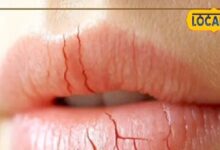 सर्दी में होंठ चाटना पड़ेगा भारी, डर्मेटोलॉजिस्ट बोले- लिप डर्मेटाइटिस से होगा दर्द, निकलेगा खून - Madhya Pradesh News