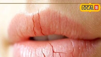 सर्दी में होंठ चाटना पड़ेगा भारी, डर्मेटोलॉजिस्ट बोले- लिप डर्मेटाइटिस से होगा दर्द, निकलेगा खून - Madhya Pradesh News