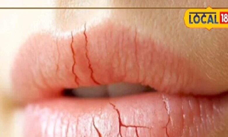 सर्दी में होंठ चाटना पड़ेगा भारी, डर्मेटोलॉजिस्ट बोले- लिप डर्मेटाइटिस से होगा दर्द, निकलेगा खून - Madhya Pradesh News