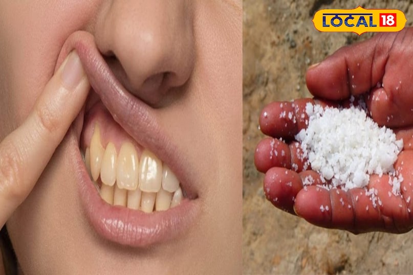 इसके अलावा बर्फ को कपड़े में लपेटकर भी सेक कर सकते है 