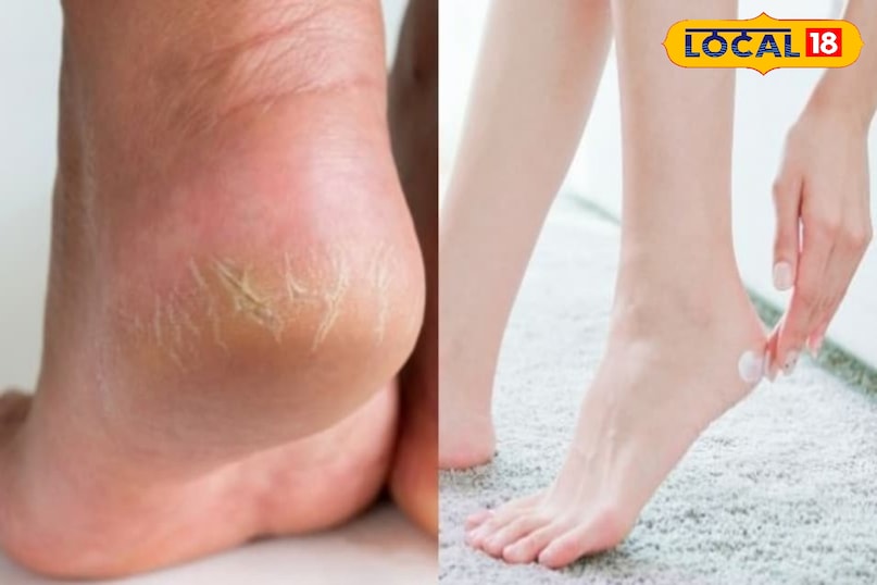 आजकल मूंगफली के छिलकों के फायदों की ओर अग्रसर हो रहे है