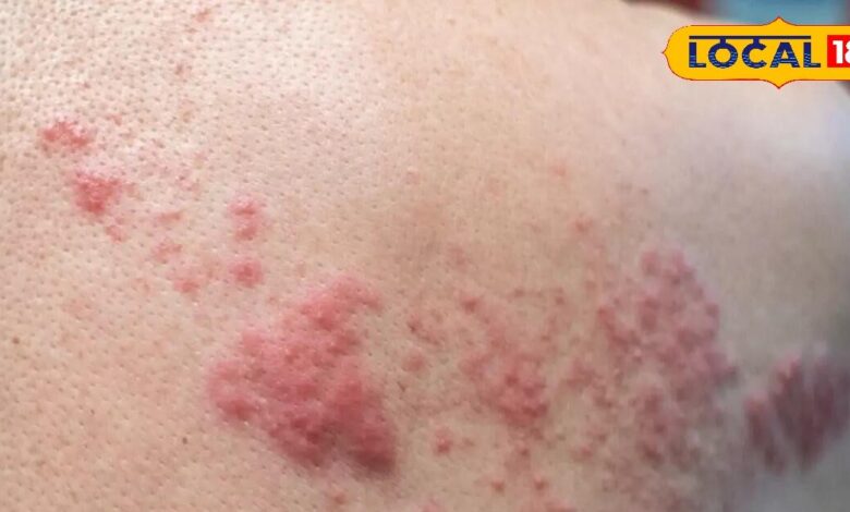 Karanj Oil Benefits | Ayurvedic Treatment for Fungal Infection | Skin Disease Ayurvedic Remedy | Karanj Tel Use | Fungal Infection Home Remedy | Ayurvedic Skin Care Tips | Natural Treatment for Skin Problems | Karanj Oil for Skin