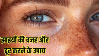 How to reduce facial Freckles: किन विटामिंस की कमी से चेहरे पर होती हैं झाइयां? कैसे करें दूर