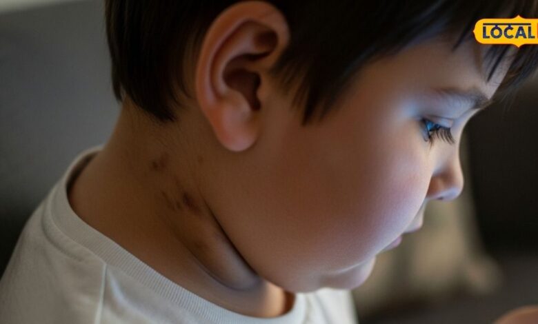 पेरेंट्स सावधान! गर्दन पर कालापन सिर्फ मैल नहीं, इस खतरनाक बीमारी की हो सकती है शुरुआत, एक्सपर्ट से जानें