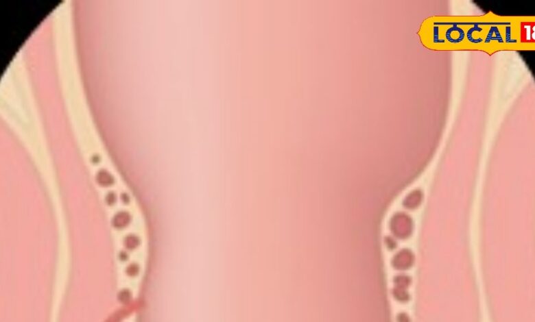 बिना ऑपरेशन भी ठीक हो सकता है फिस्टुला, ऋषिकेश में अपनाया जा रहा खास तरीका, मरीजों को मिल रही राहत - Uttarakhand News