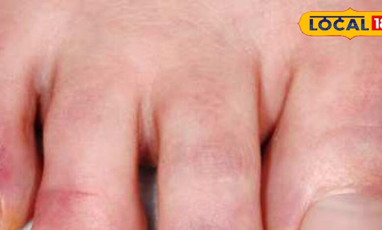 सर्दियों में उंगलियों की सूजन और दर्द से हैं परेशान? अपनाएं ये आसान घरेलू उपाय; जल्द मिलेगा आराम