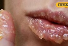 सिर्फ ठंड नहीं… ये छुपी कमी फाड़ रही है आपके होंठ!..यहां जानिए सही इलाज - Uttarakhand News