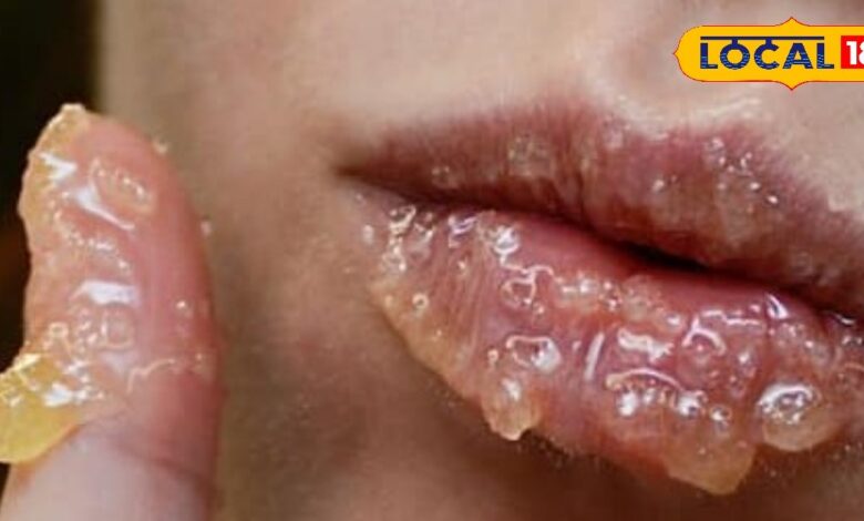 सिर्फ ठंड नहीं… ये छुपी कमी फाड़ रही है आपके होंठ!..यहां जानिए सही इलाज - Uttarakhand News