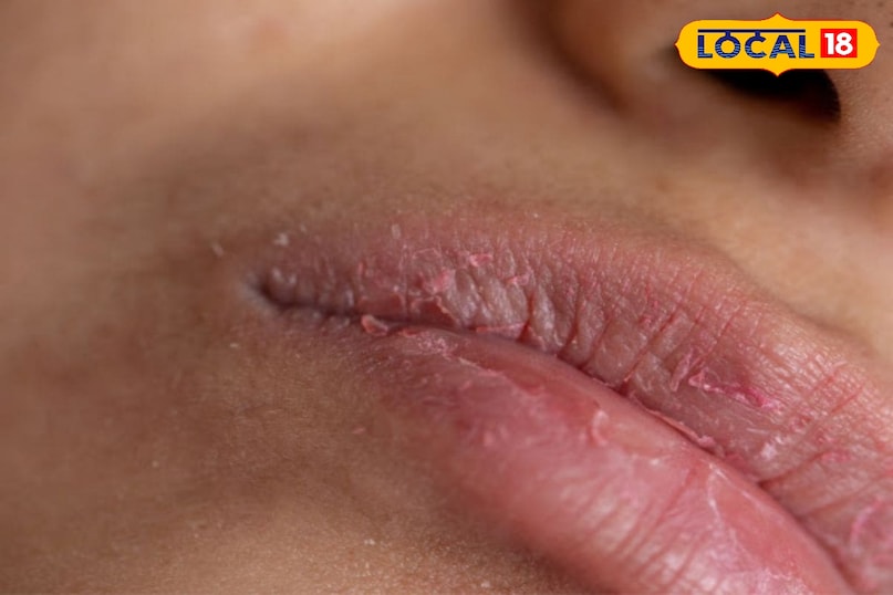 रूखे होठ 