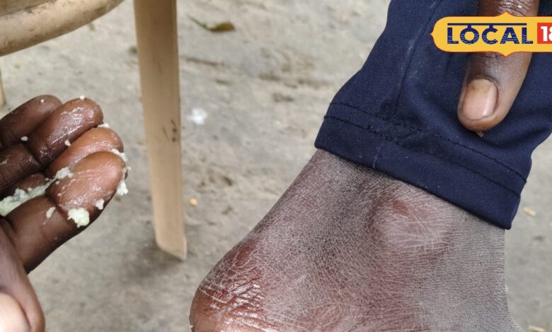 Beauty Tips If your heels are cracking in winter then just try this home remedy and it will not happen