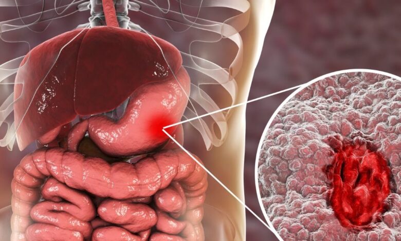 ulcer diet plan। अल्सर के मरीजों के लिए सही डाइट और खानपान के जरूरी टिप्स.