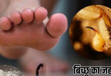 Tips To treat scorpion poisoning: तुरंत उतर जाएगा बिच्छू का जहर, करें ये 5 रामबाण उपाय