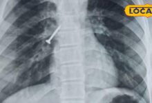 उदयपुर में मेडिकल चमत्कार! बिना ऑपरेशन और बिना बेहोशी सांस की नली से निकाला 32MM का स्क्रू