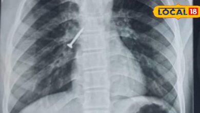 उदयपुर में मेडिकल चमत्कार! बिना ऑपरेशन और बिना बेहोशी सांस की नली से निकाला 32MM का स्क्रू