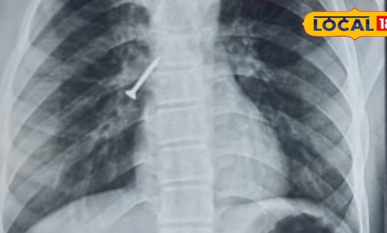 उदयपुर में मेडिकल चमत्कार! बिना ऑपरेशन और बिना बेहोशी सांस की नली से निकाला 32MM का स्क्रू