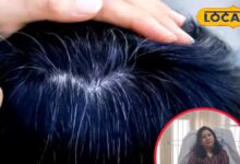 कम उम्र में बाल हो रहे हैं सफेद, तो आयुर्वेदिक डॉक्टर ने जानिए कारण और बचाव के आसान उपाय