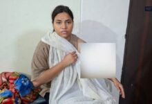 झुलसी रेशु गुप्ता के इलाज का खर्च उठाएगी सरकार, दोषी पुलिसकर्मियों पर गिरी गाज