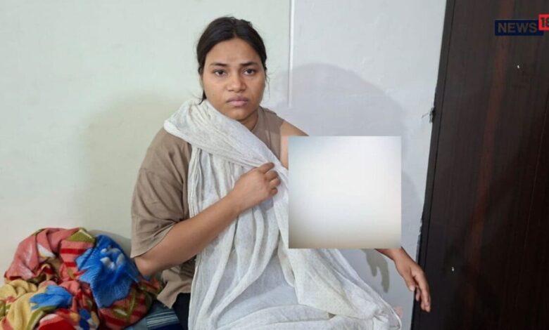 झुलसी रेशु गुप्ता के इलाज का खर्च उठाएगी सरकार, दोषी पुलिसकर्मियों पर गिरी गाज
