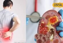 Kidney Stone: किडनी स्टोन से बचने के लिए सिर्फ पानी पीना काफी है? एक्सपर्ट ने बताया क्या खाएं और किन चीजों से बनाएं दूरी