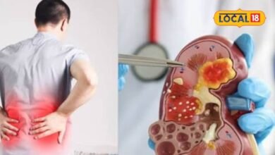 Kidney Stone: किडनी स्टोन से बचने के लिए सिर्फ पानी पीना काफी है? एक्सपर्ट ने बताया क्या खाएं और किन चीजों से बनाएं दूरी