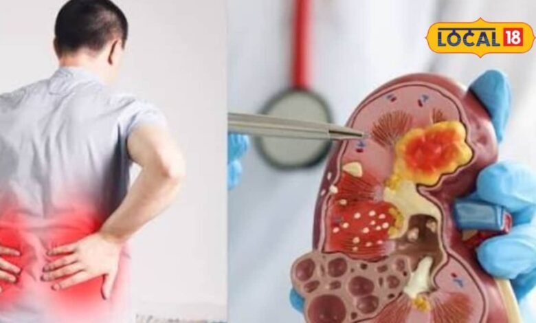 Kidney Stone: किडनी स्टोन से बचने के लिए सिर्फ पानी पीना काफी है? एक्सपर्ट ने बताया क्या खाएं और किन चीजों से बनाएं दूरी