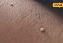 Health Tips : मस्सों ने कर रखा है परेशान? हटाने के लिए अपनाएं ये ट्रिक, नहीं पड़ेगा कोई दाग