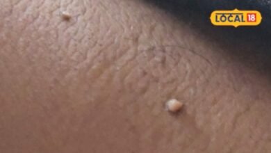 Health Tips : मस्सों ने कर रखा है परेशान? हटाने के लिए अपनाएं ये ट्रिक, नहीं पड़ेगा कोई दाग