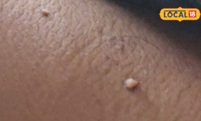 Health Tips : मस्सों ने कर रखा है परेशान? हटाने के लिए अपनाएं ये ट्रिक, नहीं पड़ेगा कोई दाग